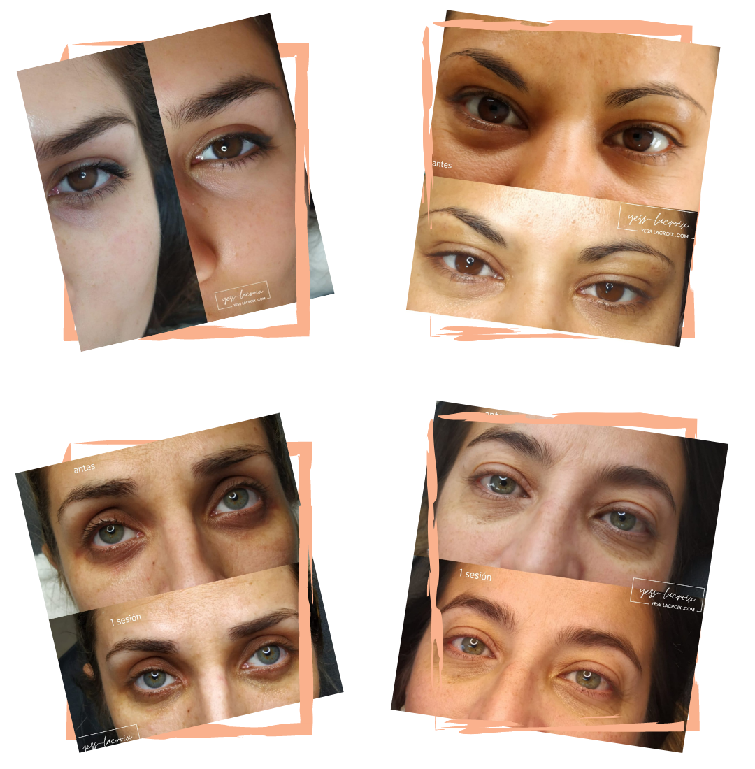 OJERAS ANTES Y DESP YESS LACROIX (1)