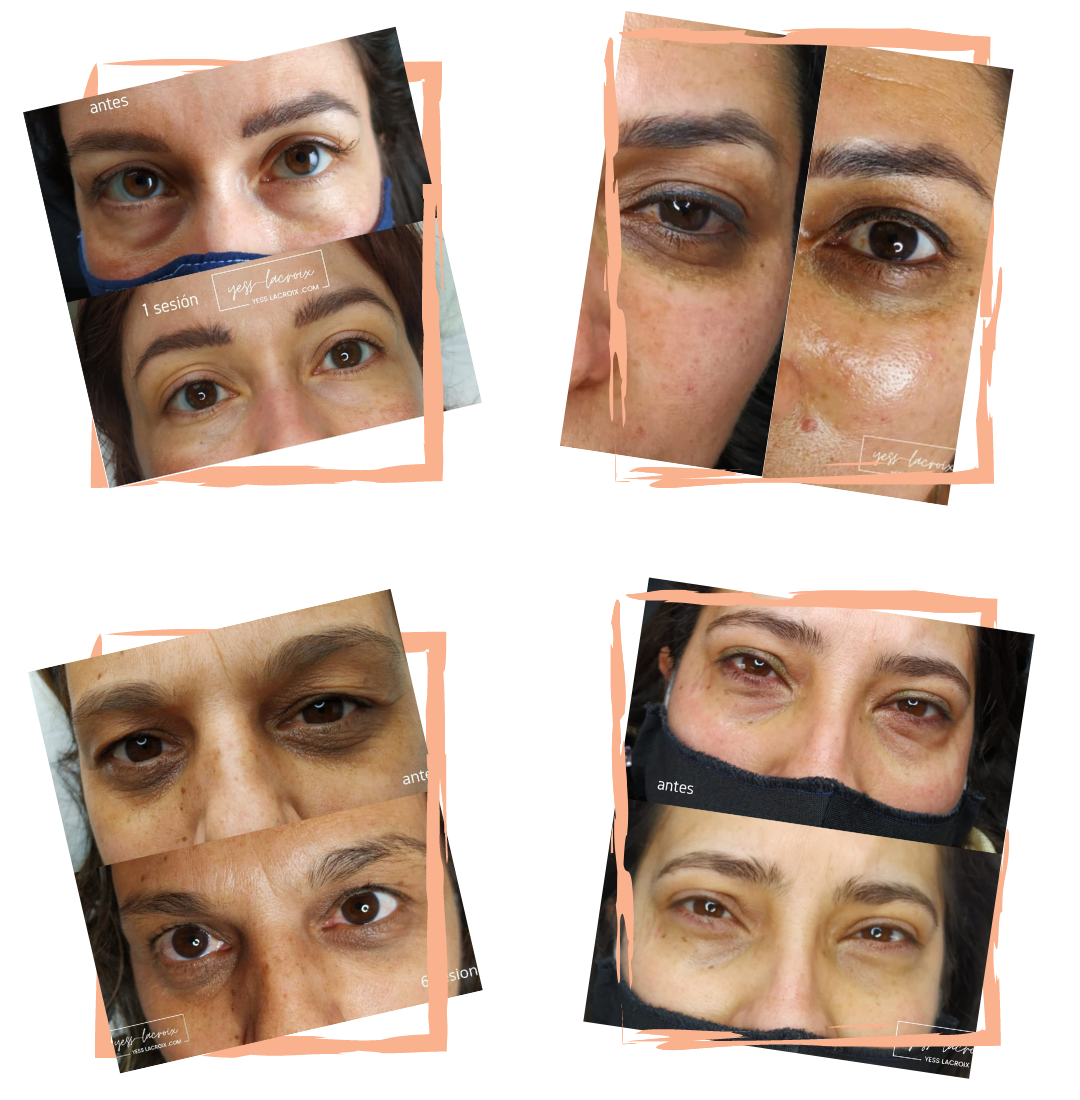 OJERAS ANTES Y DESP YESS LACROIX