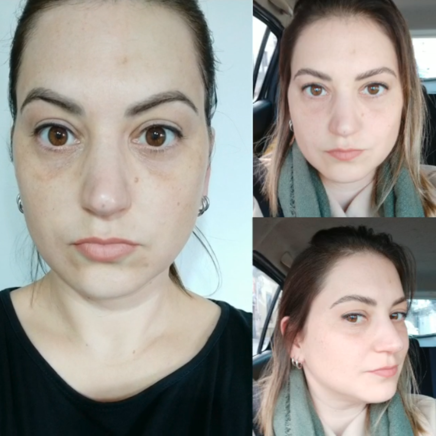 peeeling antes y despues yess lacroix