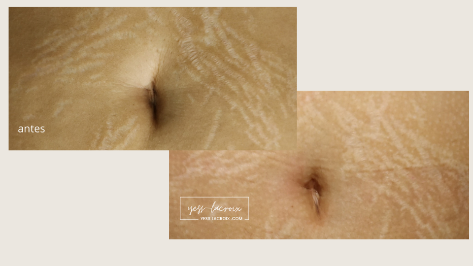 plasmapen antes y despues 1