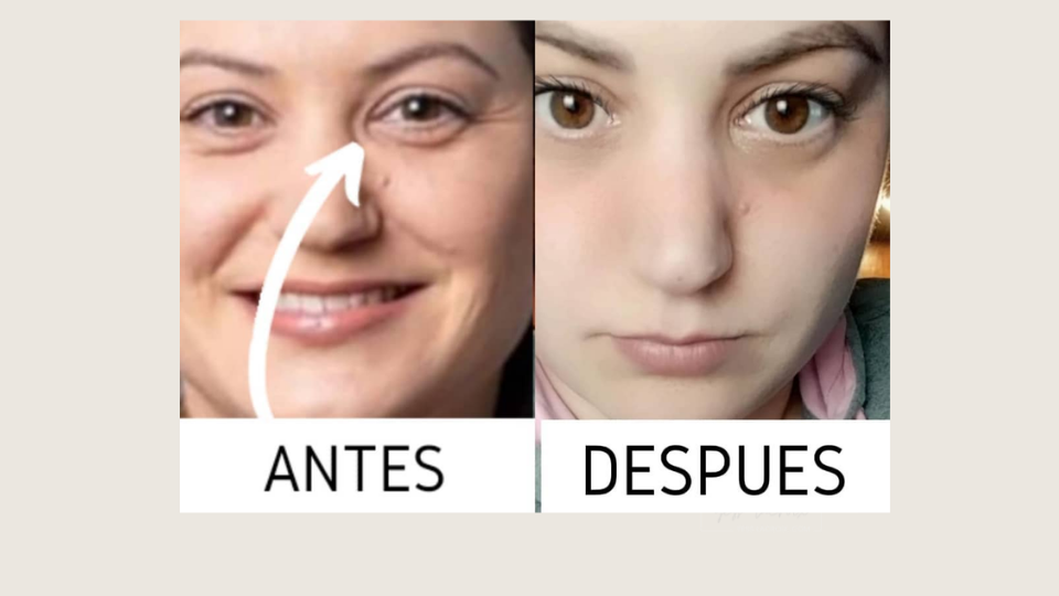 plasmapen antes y despues 6