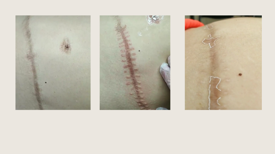 plasmapen antes y despues 8