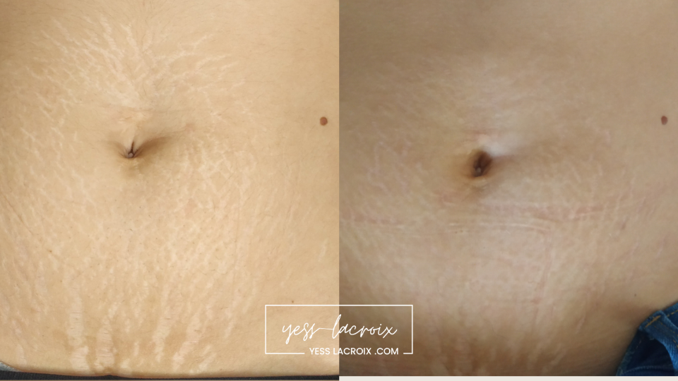 plasmapen estrias antes y despues yess lacroix