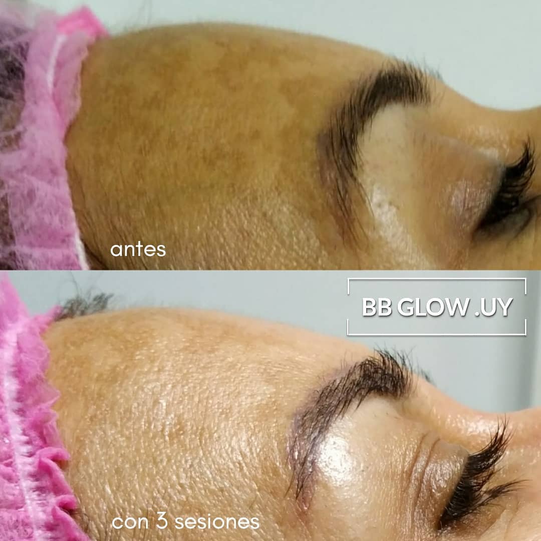 bbglow antes y después bbglow antes y después