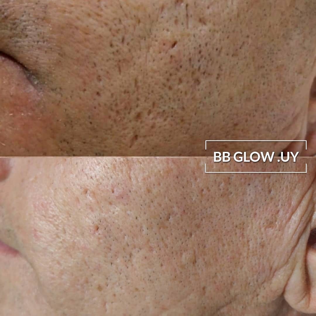 bbglow antes y después bbglow antes y después