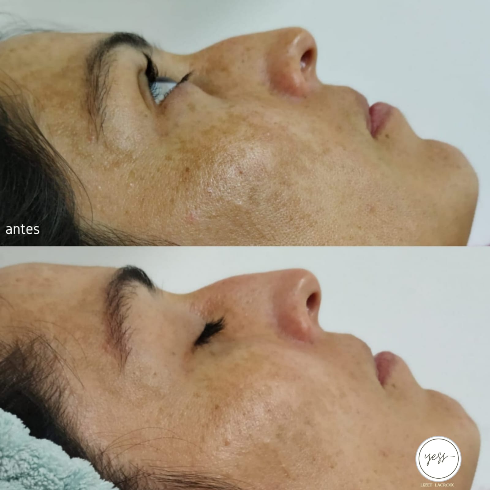 bbglow antes y después bbglow antes y después