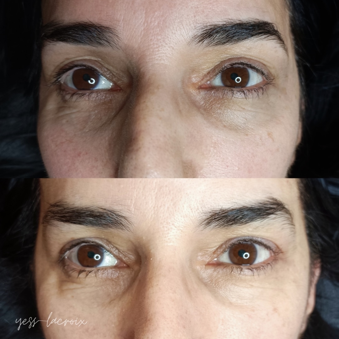 Camuflaje de Ojeras antes y despues