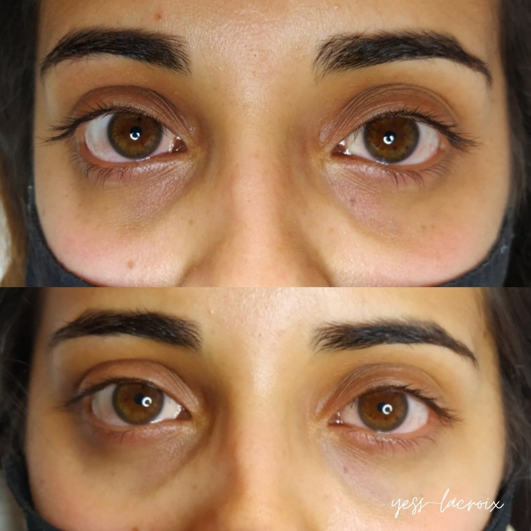 Camuflaje de Ojeras antes y despues