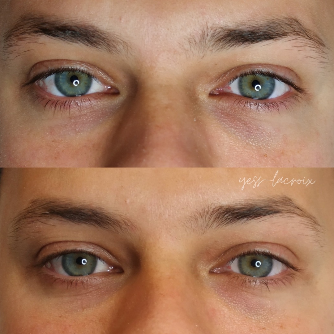 Camuflaje de Ojeras antes y despues