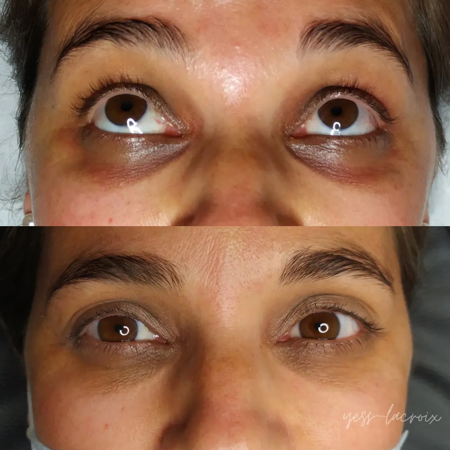 Camuflaje de Ojeras antes y despues
