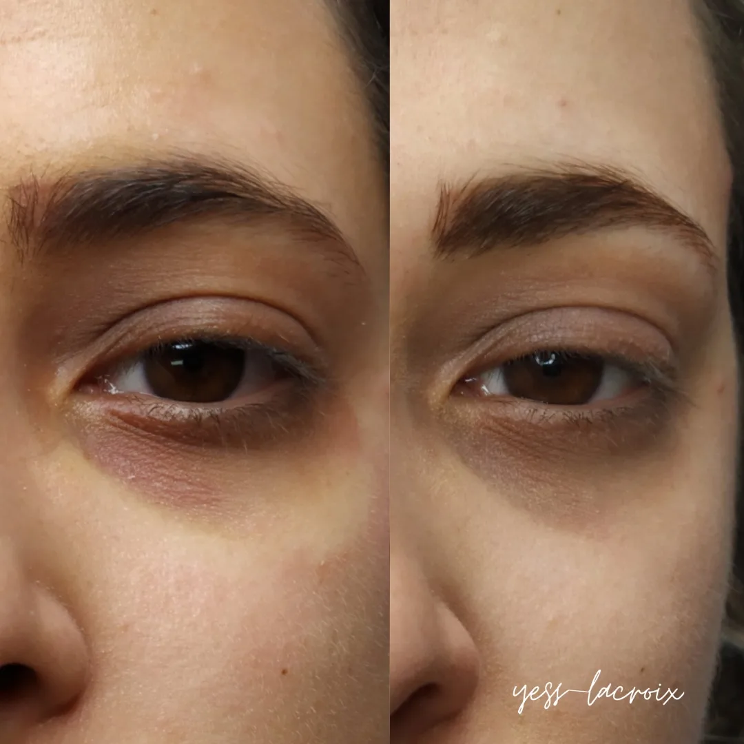 Camuflaje de Ojeras antes y despues