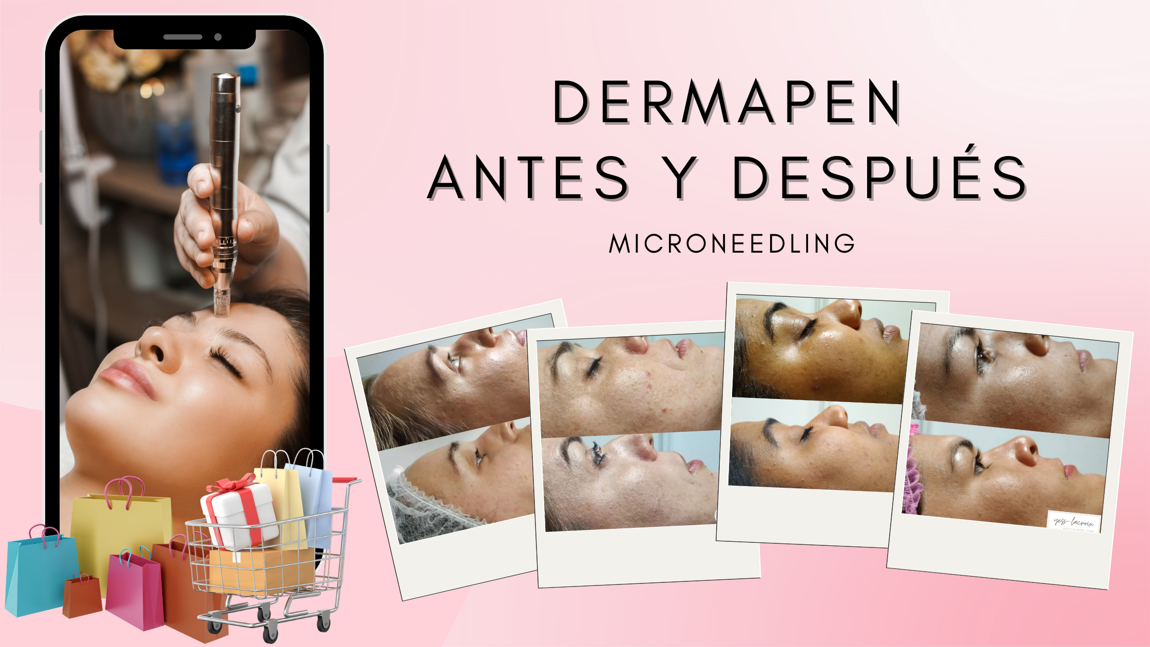 Dermapen antes y después